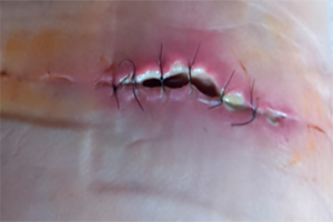 Deiscência de sutura